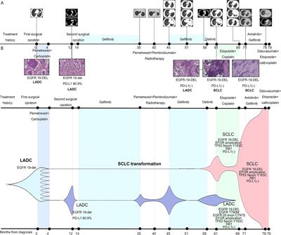 Case Report: Re-Sensitization to Gefitinib in Lung Adenocarcinoma Harboring EGFR Mutation and High PD-L1 Expression After Immunotherapy Resistance, Which Finally Transform Into Small Cell Carcinoma